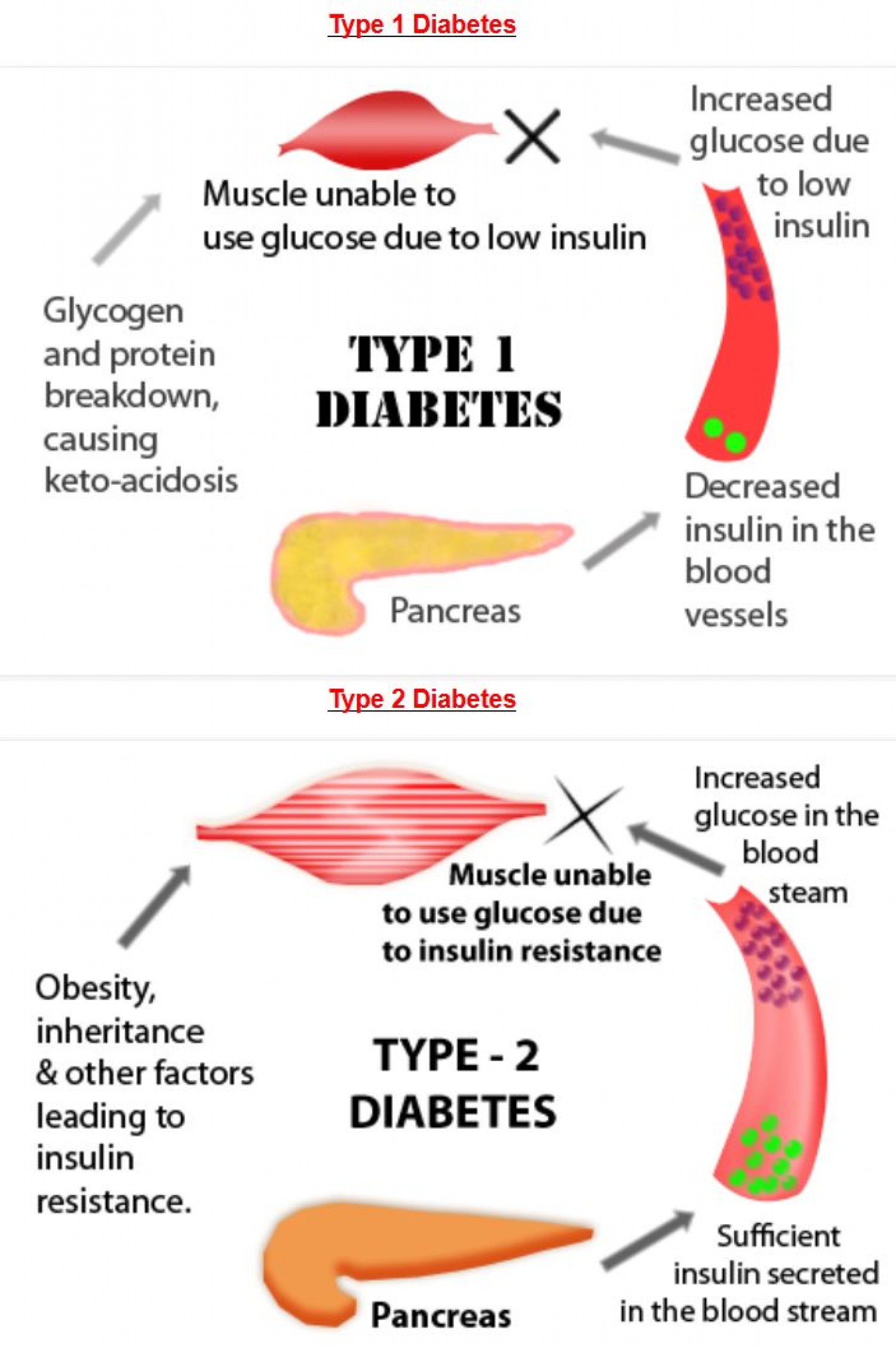 Good Deals For Tiene Cura La Diabetes Insipida C?digos promocionales ...